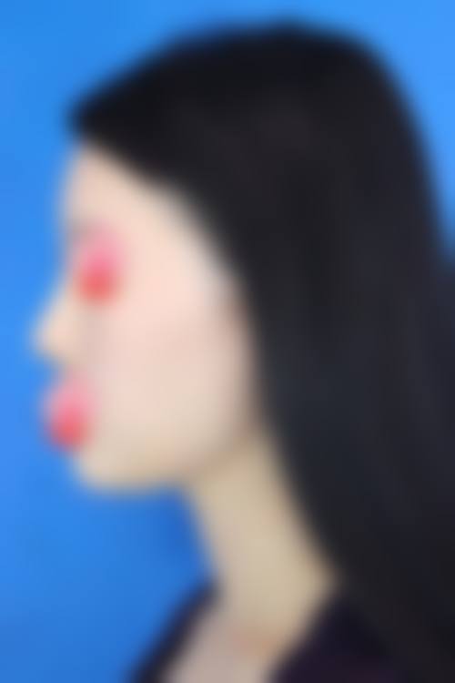 洛阳解放军 534 医院美容整形科实例参考