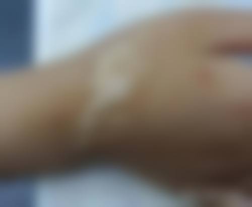 北京国丹医院皮肤科（疤痕）实例参考