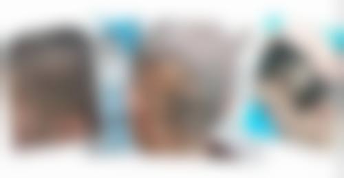 青岛海伦美容医院植发科核心项目