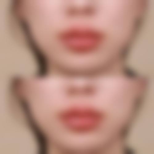 韩国特怡斯整形医院实例参考