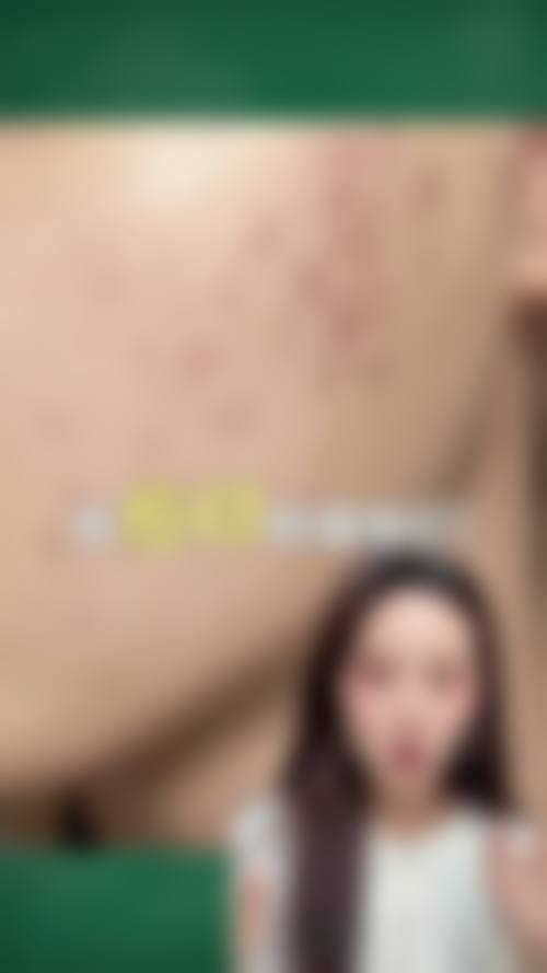 韩国江南丽兹RITZ整形皮肤科实例参考