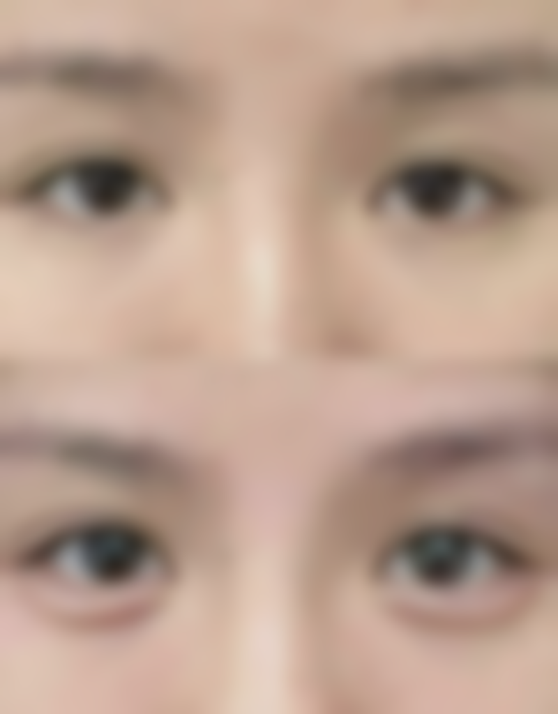 沈阳和平李淼整形医院实例参考