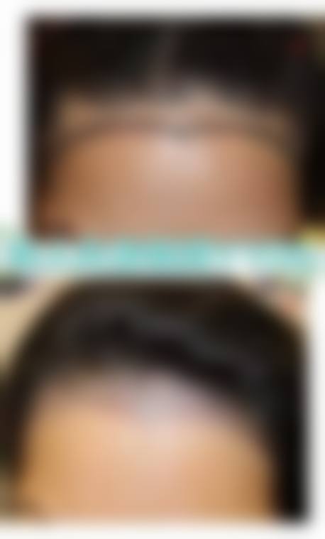 昆山新生植发擅长项目