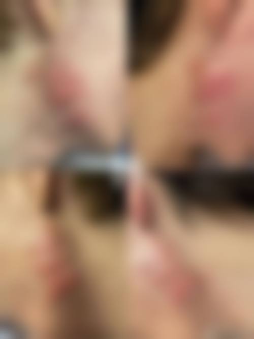 河池市人民医院烧伤整形外科实例参考