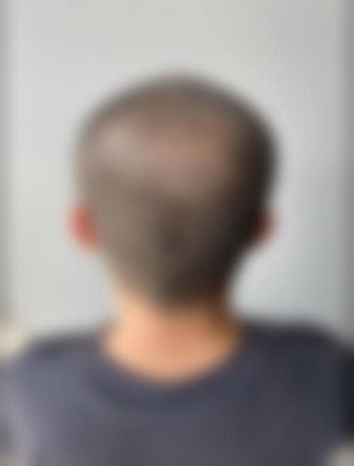 宁夏银川首欣植发怎么预约？