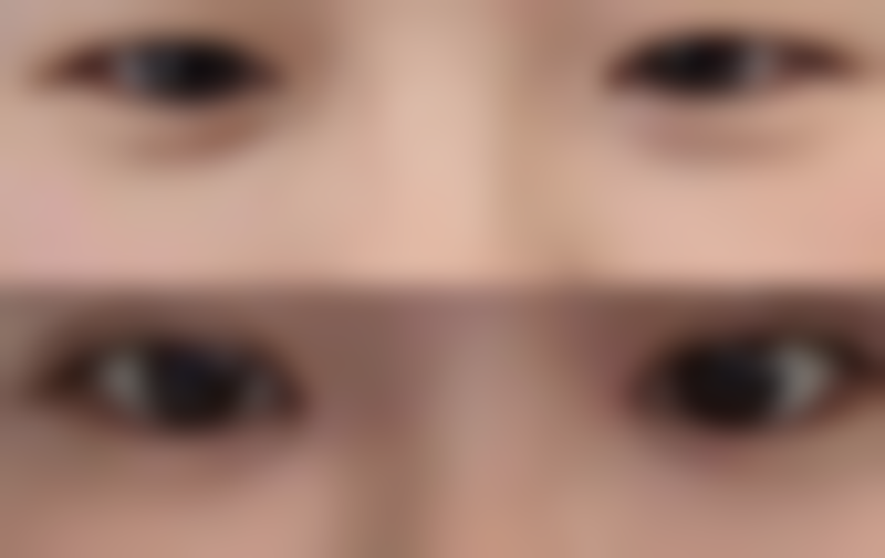 南昌伊莲梵恩整形医院实例参考