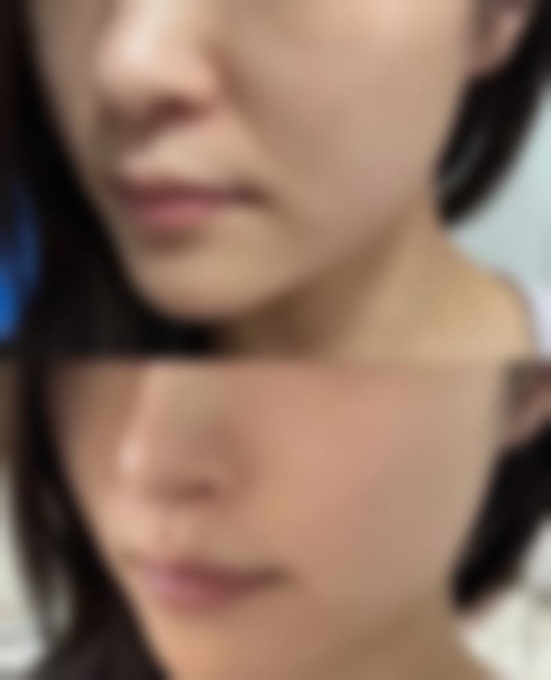 韩国琉璐珍整形医院实例参考