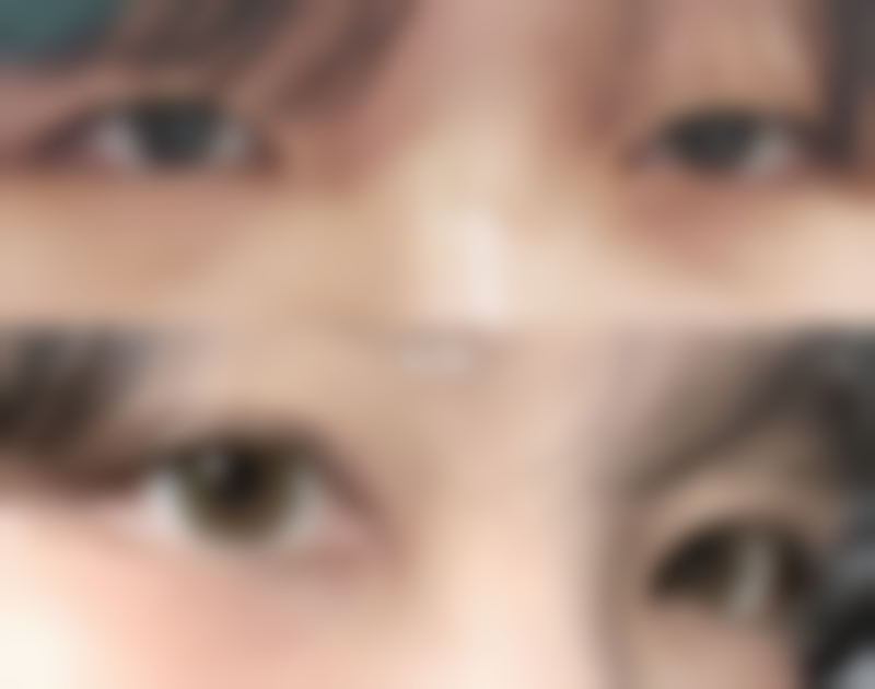 新疆医 科 大学第五附属医院整形美容科实例参考