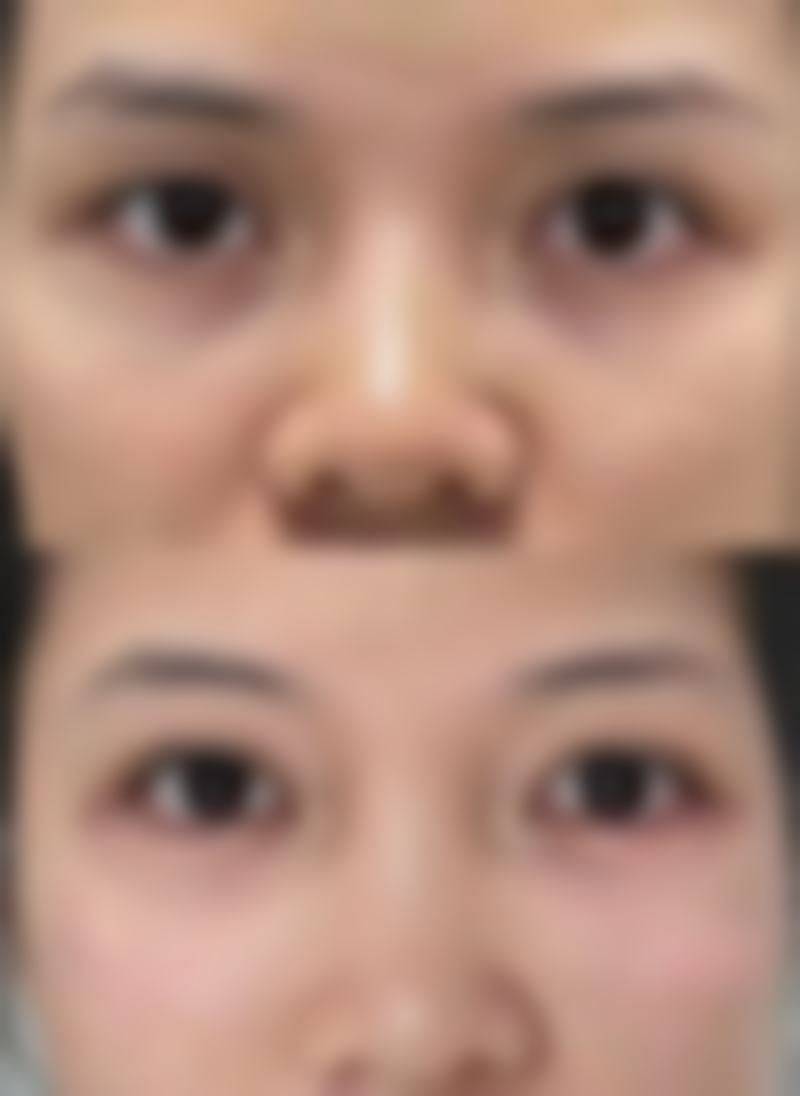 深圳韩秀玉颜玺整形医院实例参考