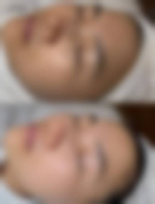 佛山禅城叶玉红整形医院实例参考