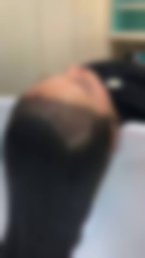 芜湖雍禾植发医院实例参考