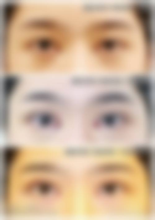 杭州臻靓整形医院实例参考