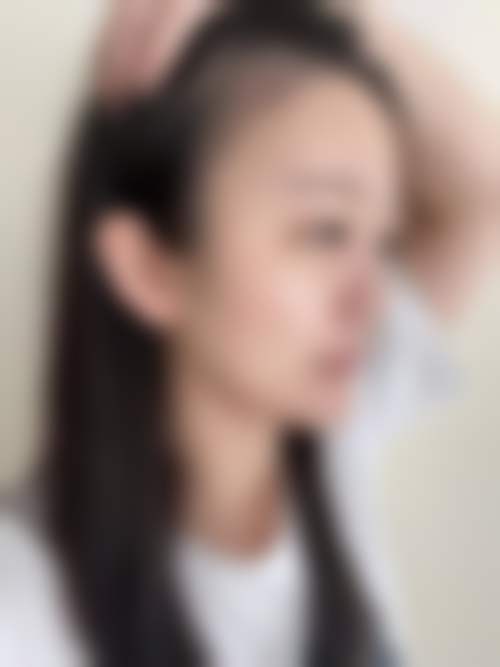 昆明育森植发医院临床典型服务范例