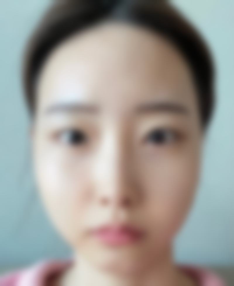 手术那天,和术后的惊喜变化