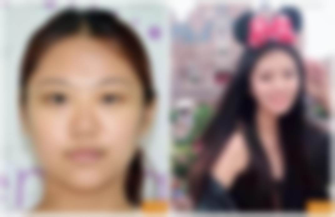 伊婉C 1ml玻尿酸除皱项目:科学抚纹,重现年轻