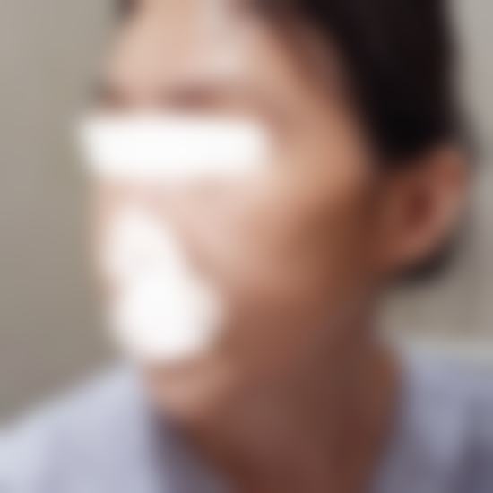 我讨厌的颧弓突出和下颌菱角，终于变成柔和线条了