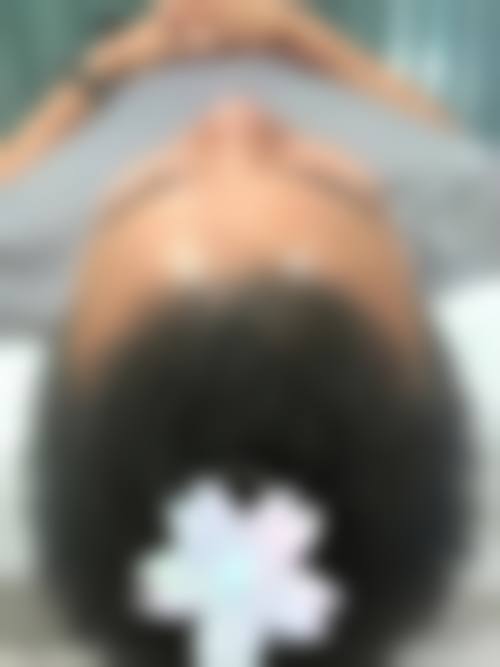 长沙大麦微针植发项目价格参考