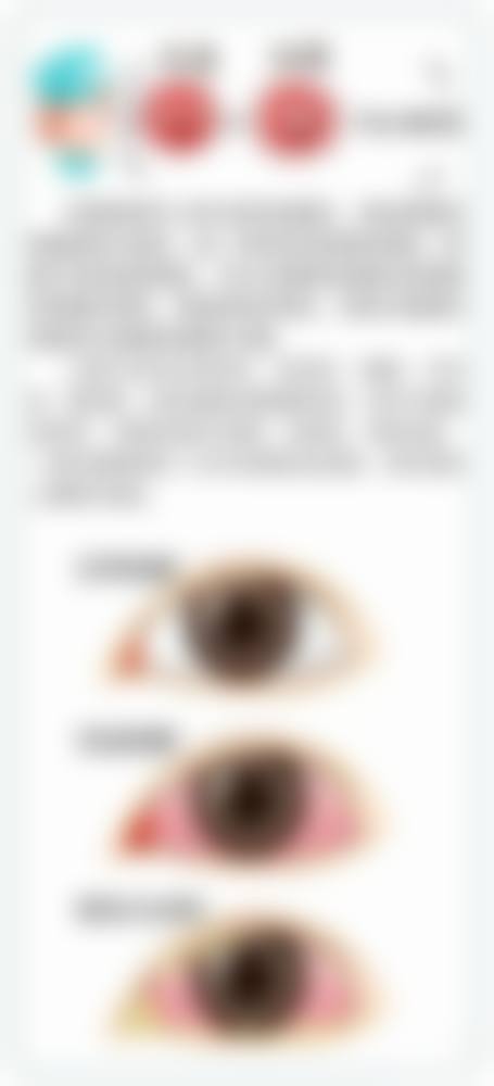 优惠活动详情:公益复明,减轻患者负担